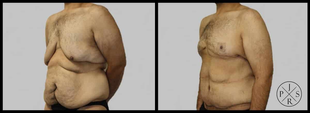 Body Lift Before & After Image