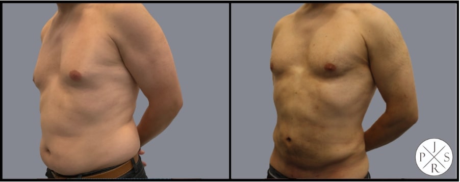 Liposuction Before & After Image