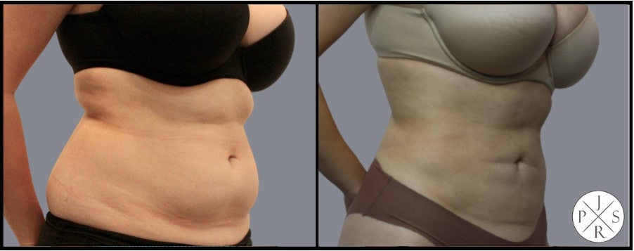 Liposuction Before & After Image