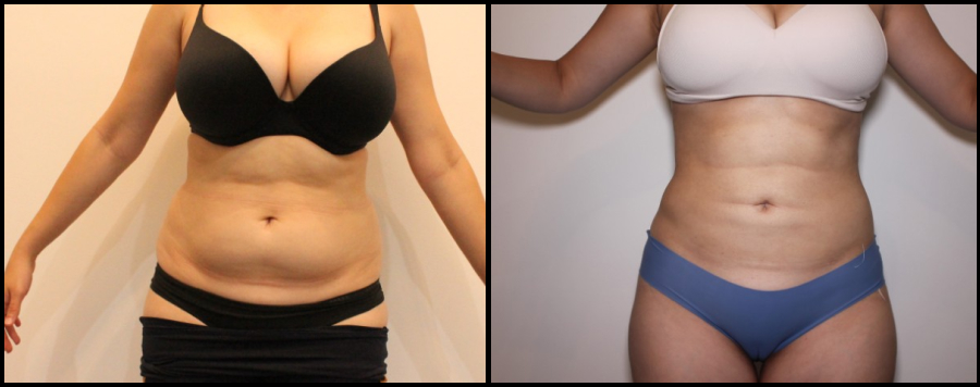 Liposuction Before & After Image