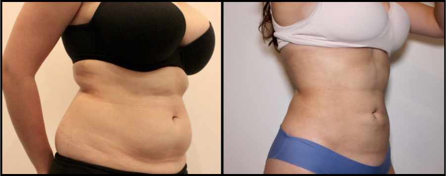 Liposuction Before & After Image