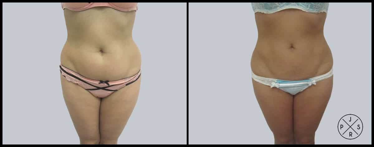 Liposuction Before & After Image