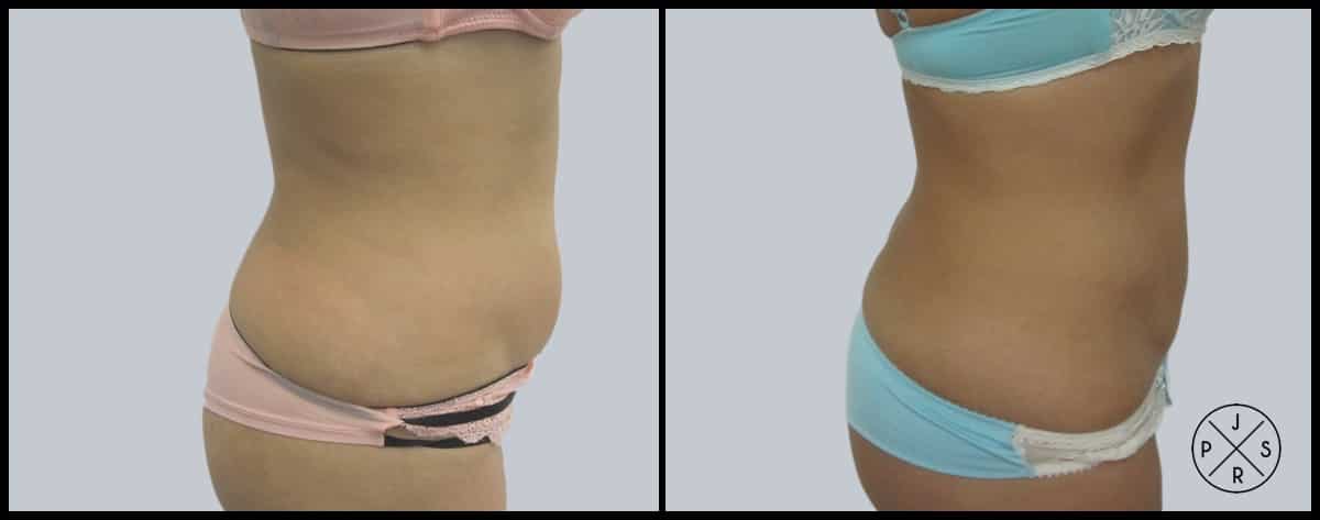 Liposuction Before & After Image