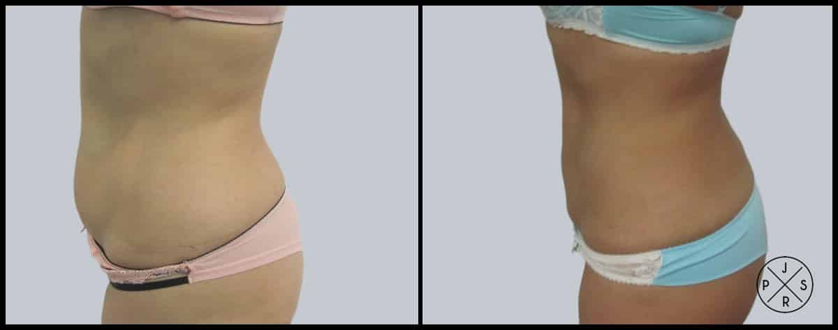 Liposuction Before & After Image