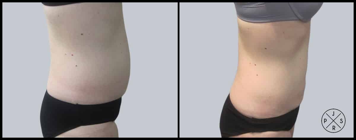 Liposuction Before & After Image