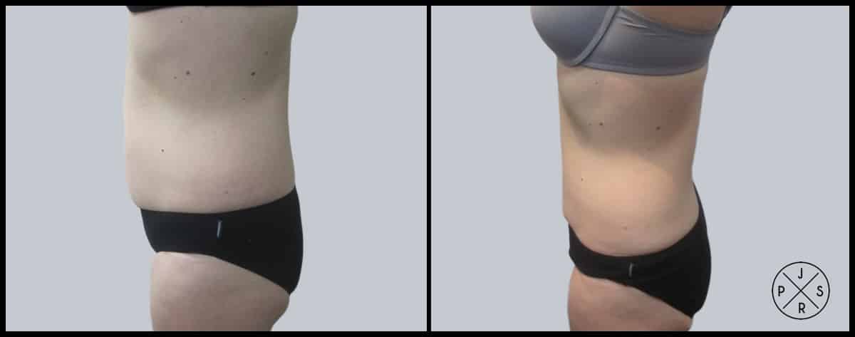 Liposuction Before & After Image