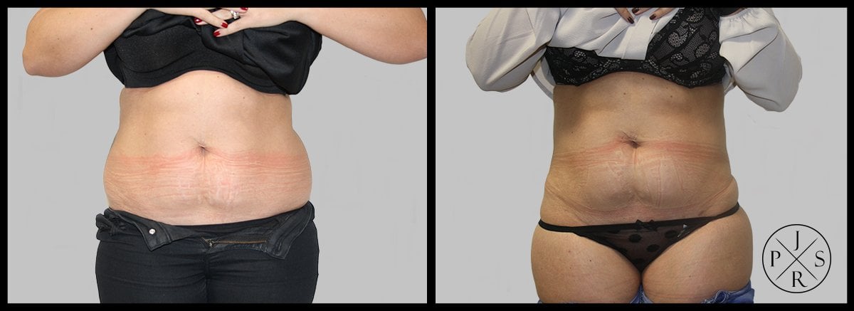 Liposuction Before & After Image