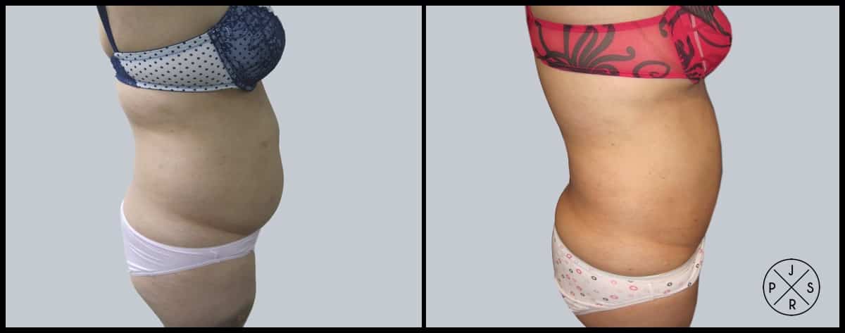 Liposuction Before & After Image