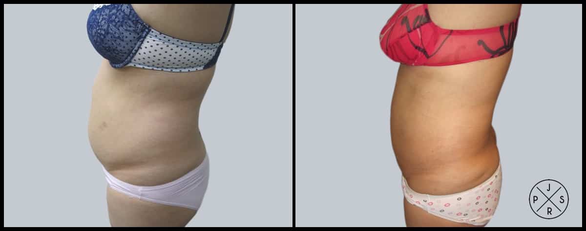 Liposuction Before & After Image