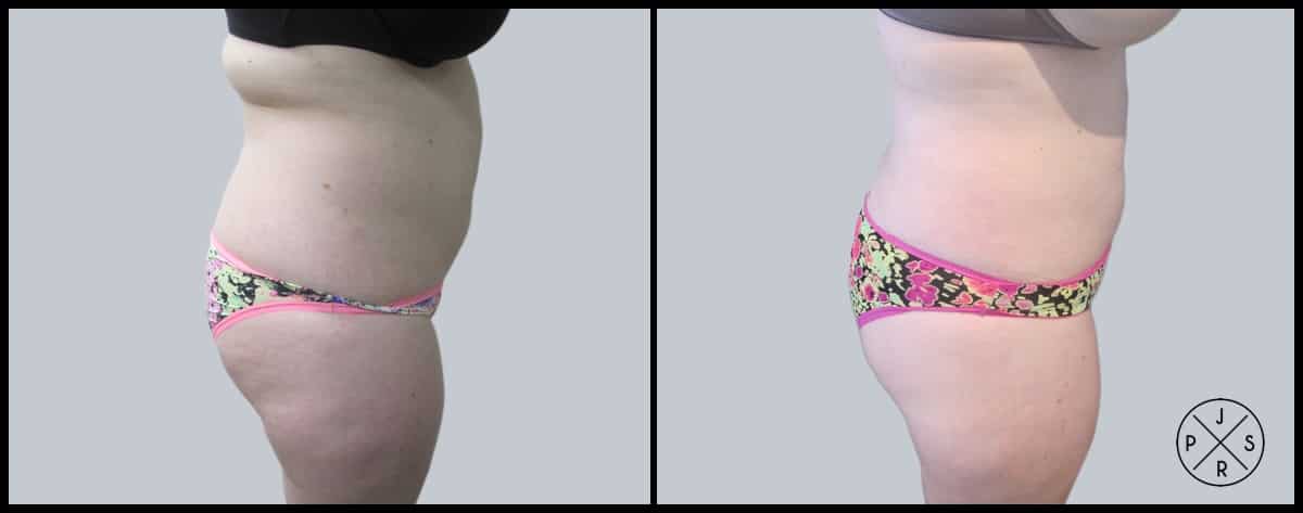 Liposuction Before & After Image