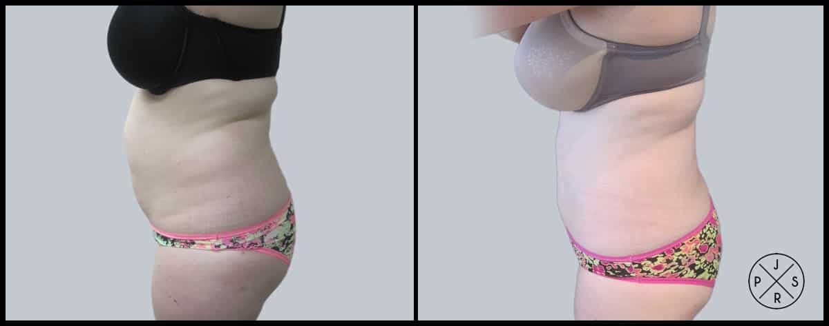 Liposuction Before & After Image