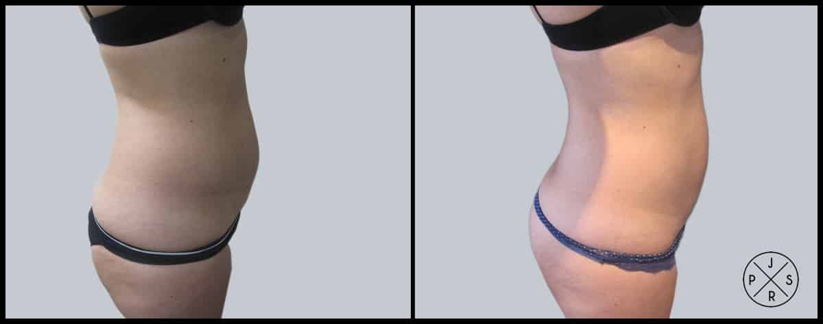 Liposuction Before & After Image