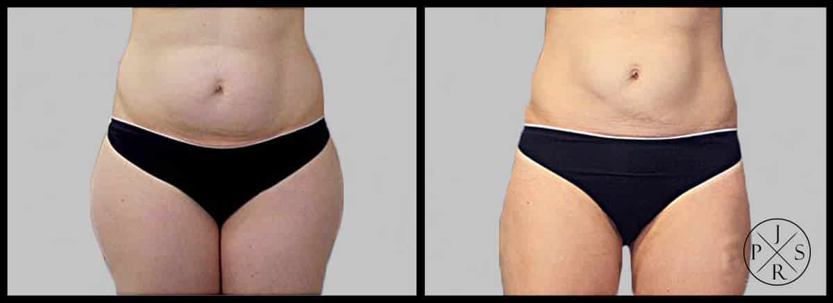 Liposuction Before & After Image