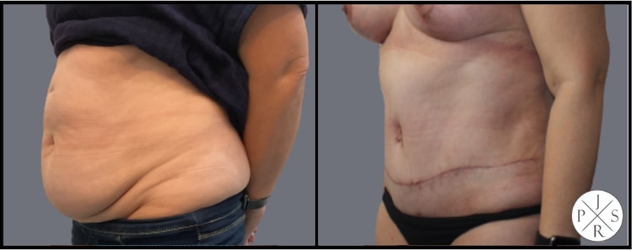 Abdominoplasty Before & After Image