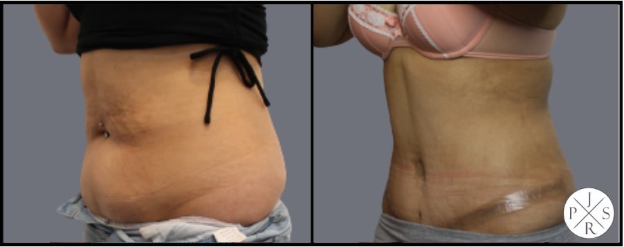 Abdominoplasty Before & After Image