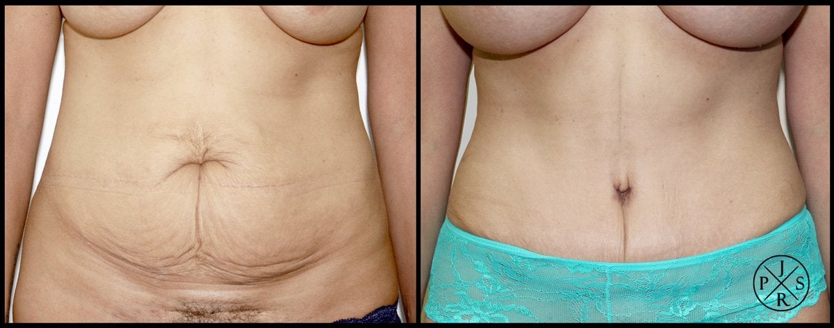 Abdominoplasty Before & After Image