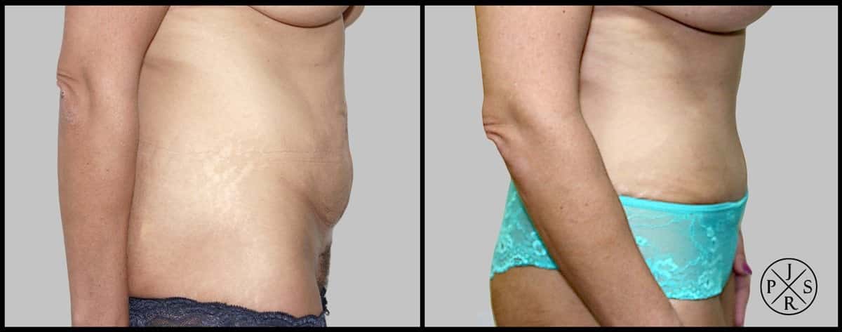 Abdominoplasty Before & After Image