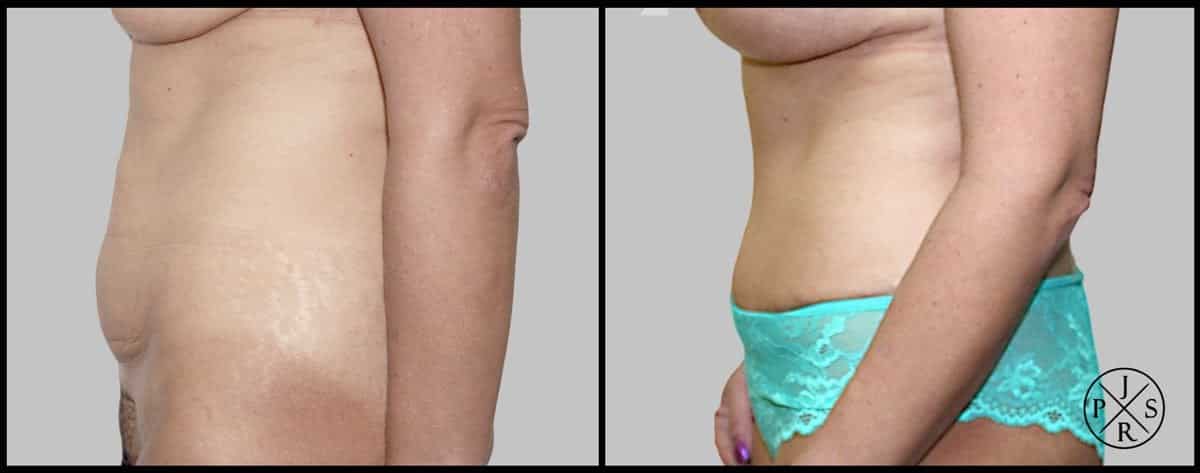 Abdominoplasty Before & After Image