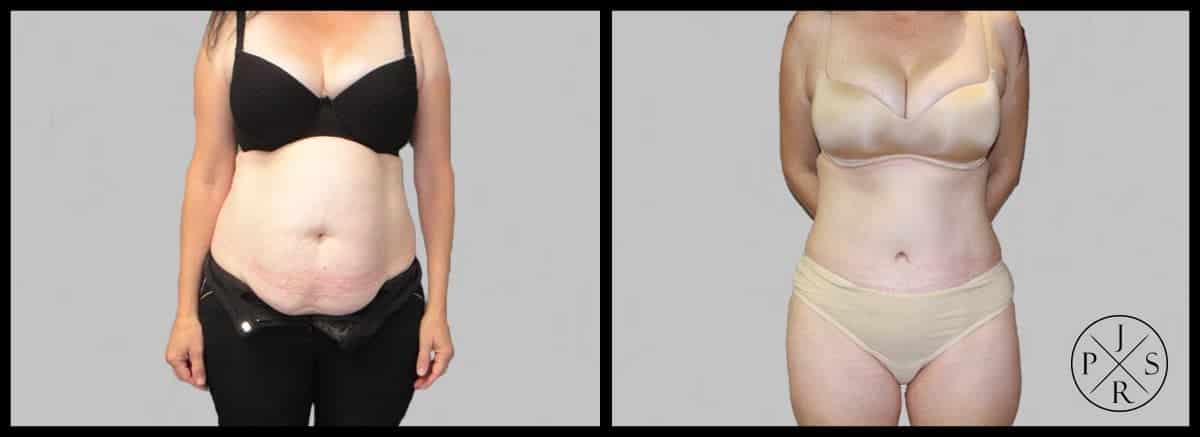 Abdominoplasty Before & After Image