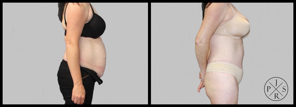 Abdominoplasty Before & After Image