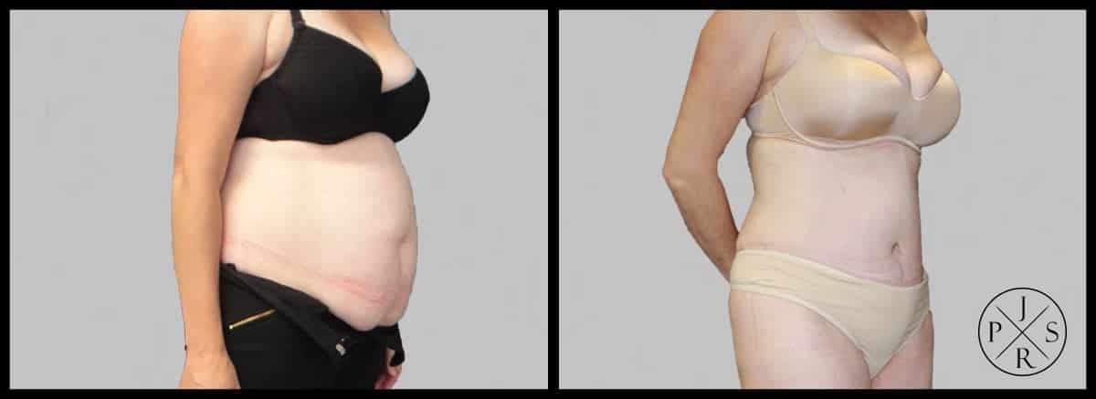 Abdominoplasty Before & After Image