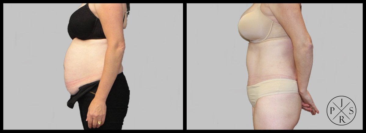 Abdominoplasty Before & After Image