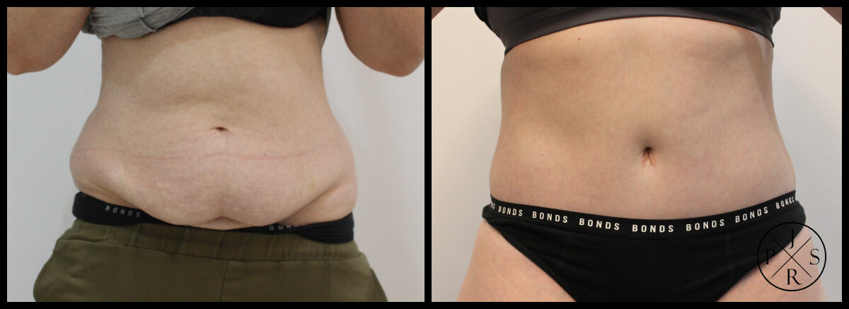 Abdominoplasty Before & After Image