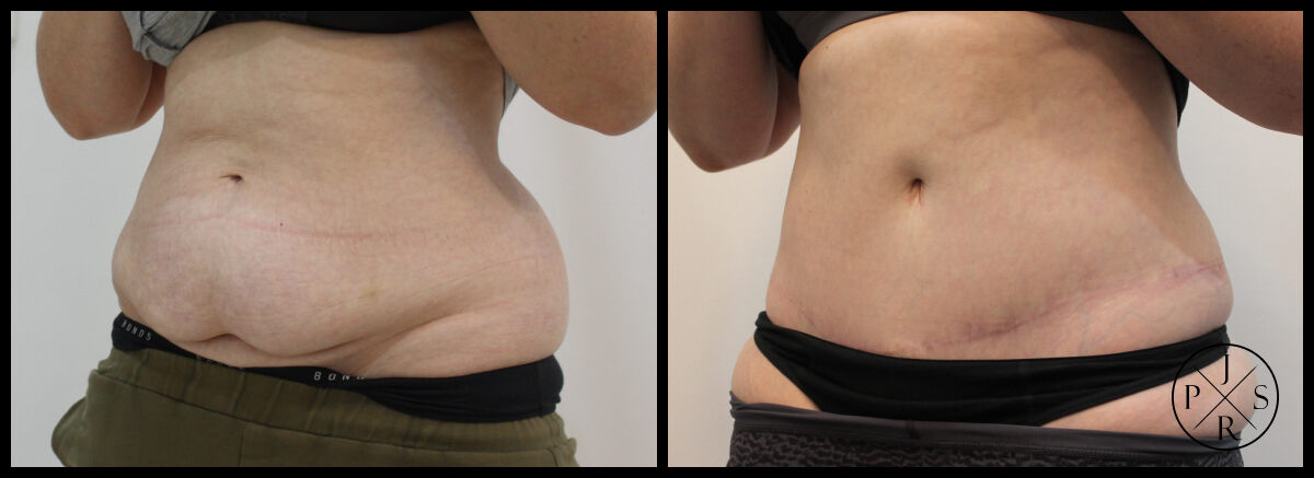 Abdominoplasty Before & After Image