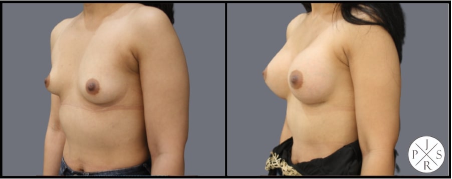 Breast Augmentation Before & After Image