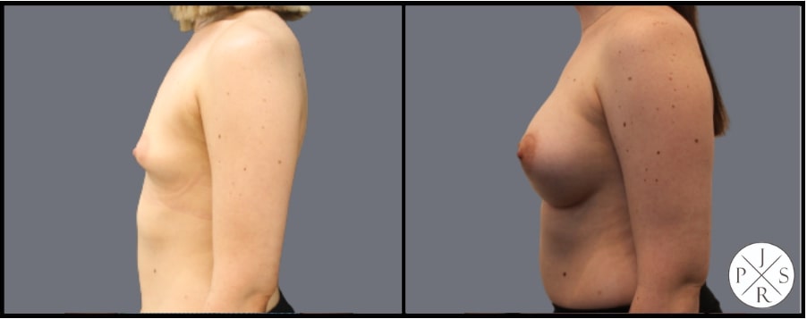 Breast Augmentation Before & After Image