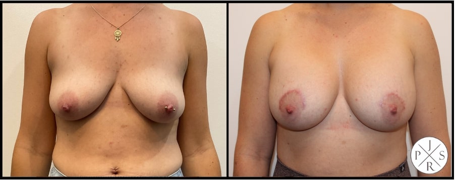 Breast Augmentation Before & After Image