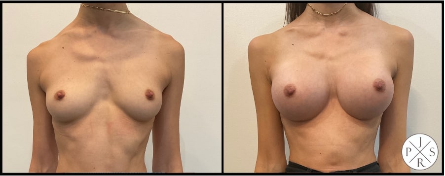Breast Augmentation Before & After Image