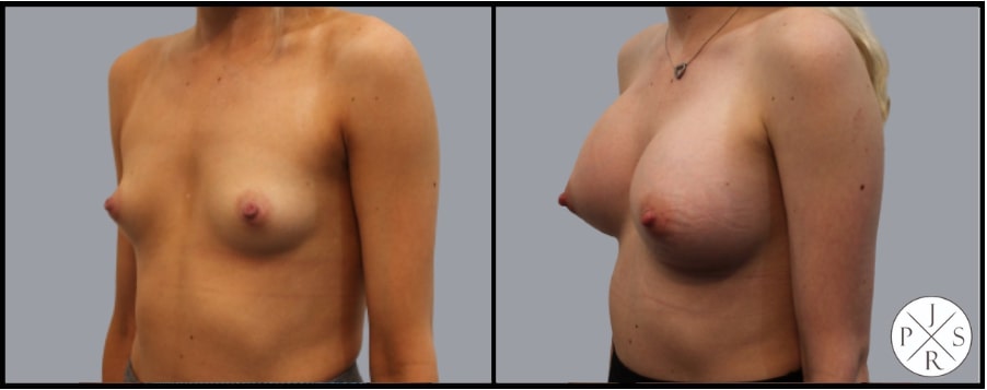 Breast Augmentation Before & After Image