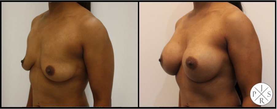 Breast Augmentation Before & After Image