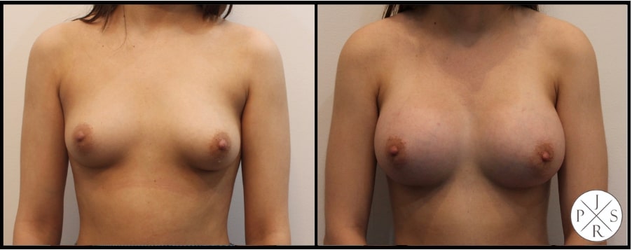 Breast Augmentation Before & After Image