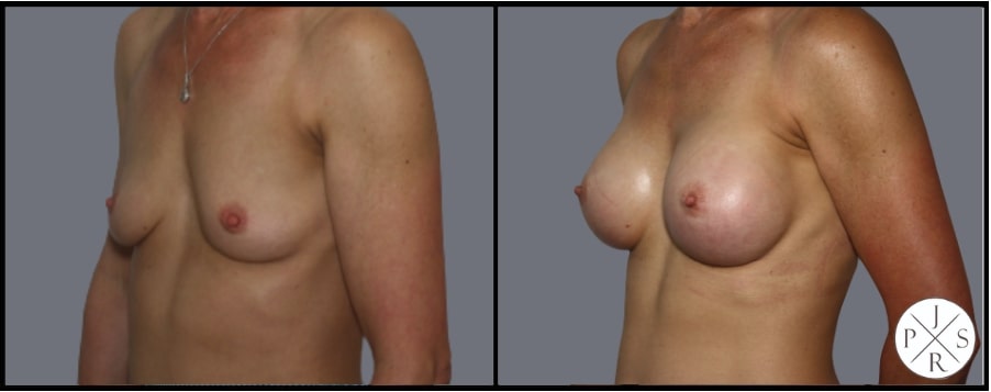 Breast Augmentation Before & After Image