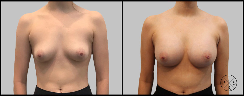 Breast Augmentation Before & After Image