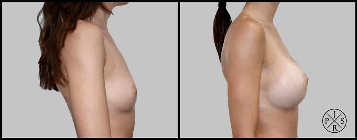 Breast Augmentation Before & After Image