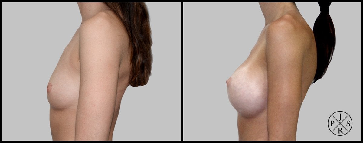 Breast Augmentation Before & After Image