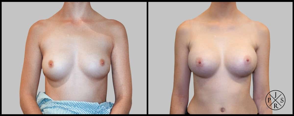 Breast Augmentation Before & After Image