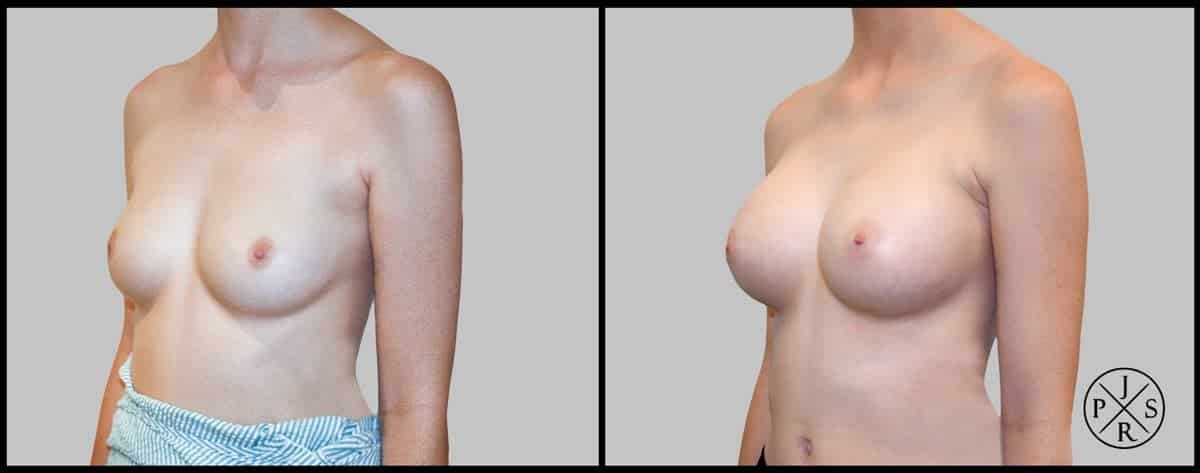 Breast Augmentation Before & After Image