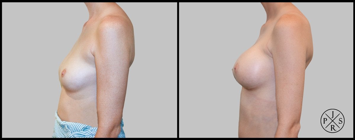 Breast Augmentation Before & After Image