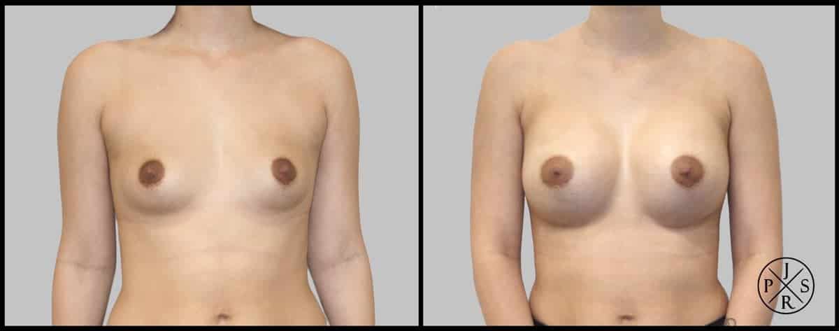 Breast Augmentation Before & After Image