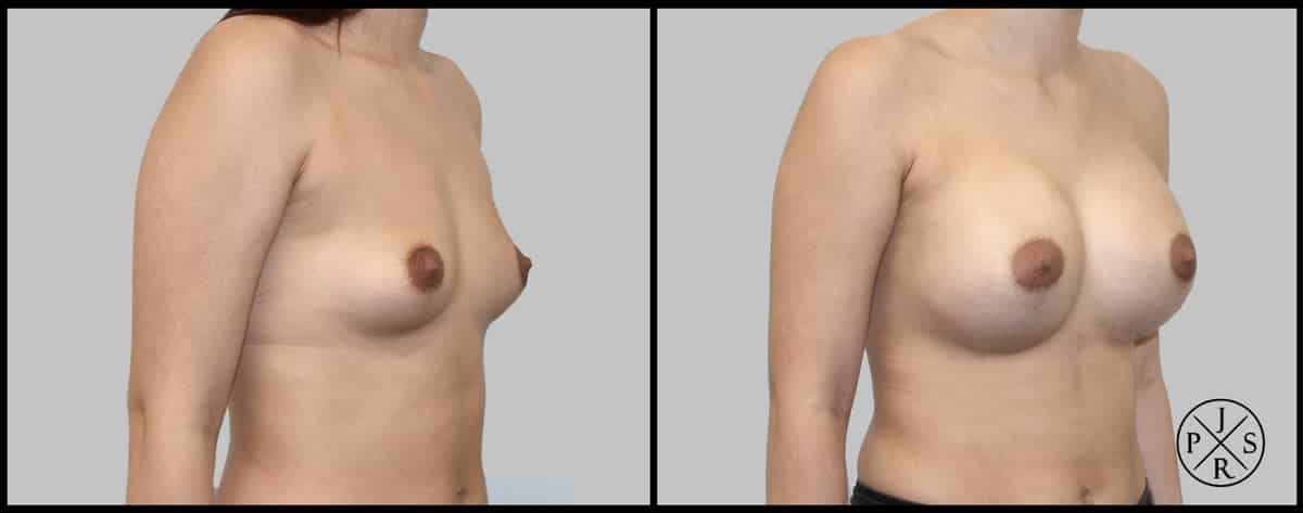 Breast Augmentation Before & After Image