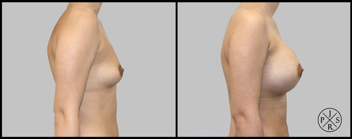 Breast Augmentation Before & After Image