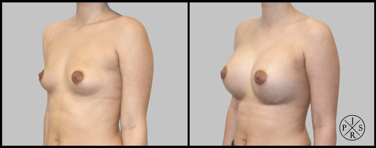 Breast Augmentation Before & After Image