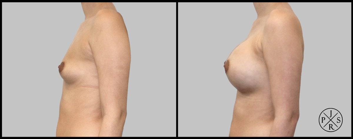 Breast Augmentation Before & After Image