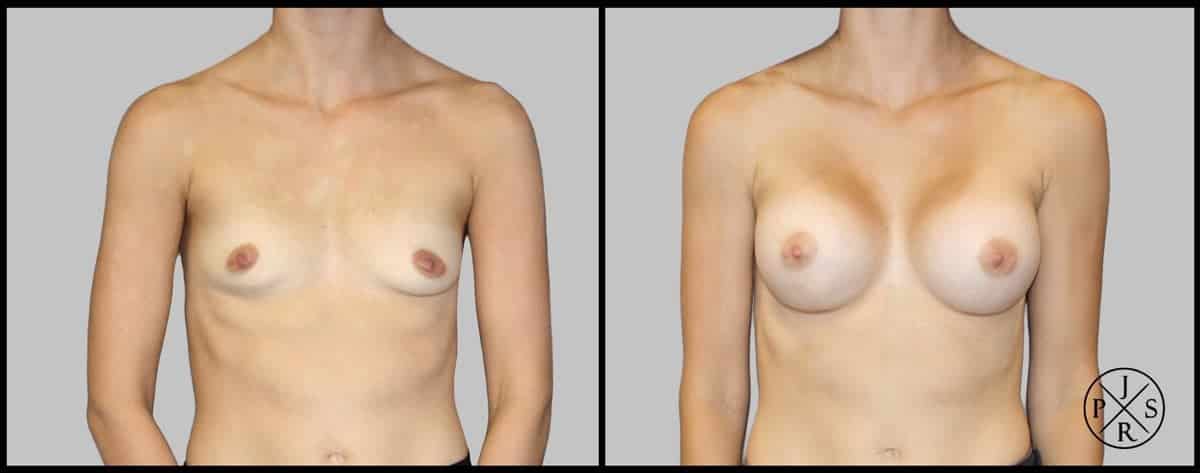 Breast Augmentation Before & After Image