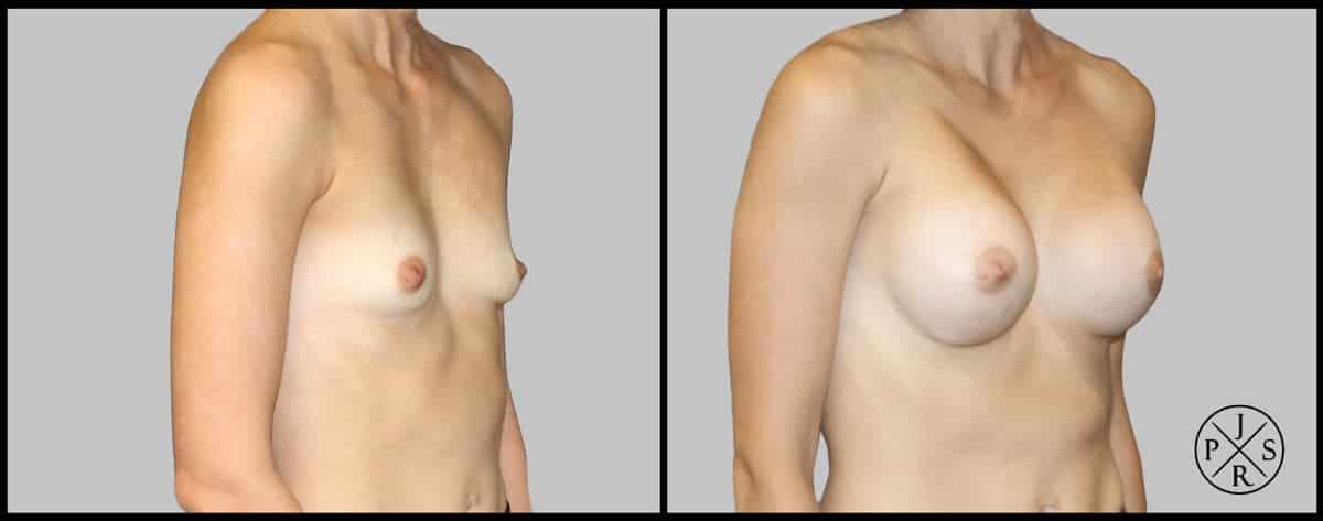 Breast Augmentation Before & After Image