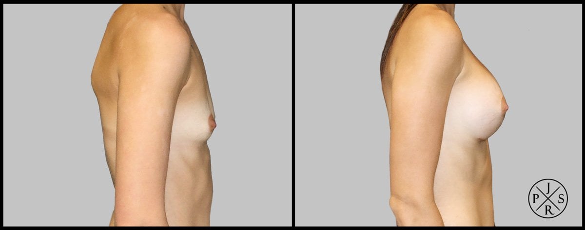 Breast Augmentation Before & After Image